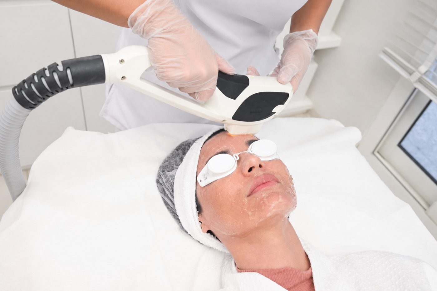 IPL photorejuvenation treatment